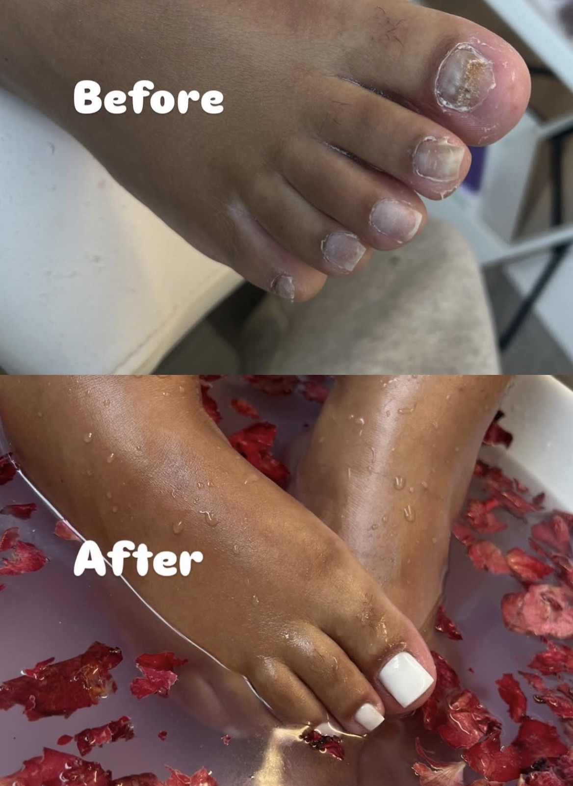 Voor en na een kalknagelbehandeling: dezelfde voet eerst met beschadigde nagels, daarna verzorgd met witte teennagels in een voetenbad met rozenblaadjes
